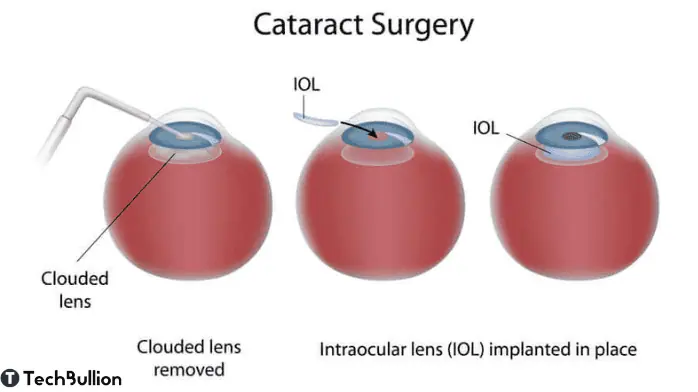 cataract surgery