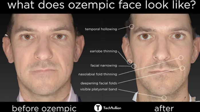 ozempic face